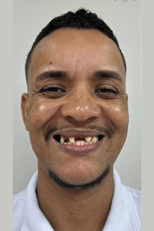 Dentes antes do tratamento