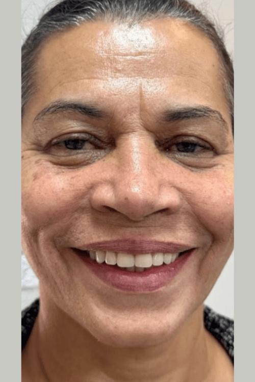 Sorriso depois do tratamento