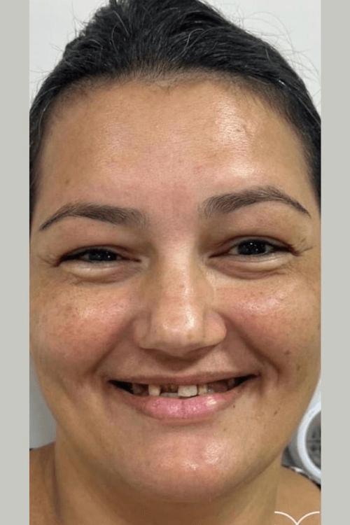 Dentes antes do tratamento